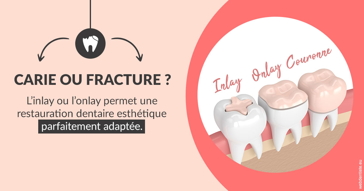 https://dr-bounet-philippe.chirurgiens-dentistes.fr/T2 2023 - Carie ou fracture 2