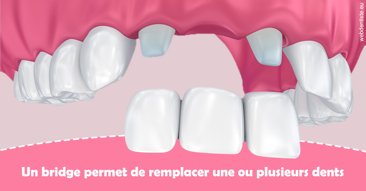 https://dr-bounet-philippe.chirurgiens-dentistes.fr/Bridge remplacer dents 2