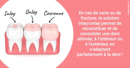 https://dr-bounet-philippe.chirurgiens-dentistes.fr/L'INLAY ou l'ONLAY 2