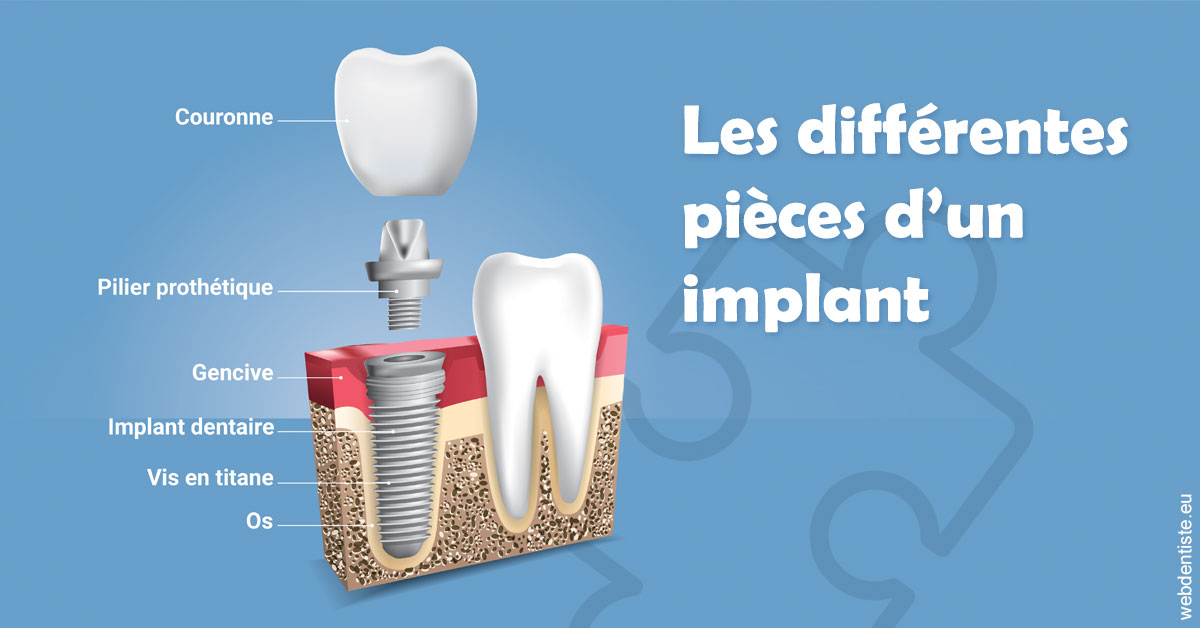 https://dr-bounet-philippe.chirurgiens-dentistes.fr/Les différentes pièces d’un implant 1